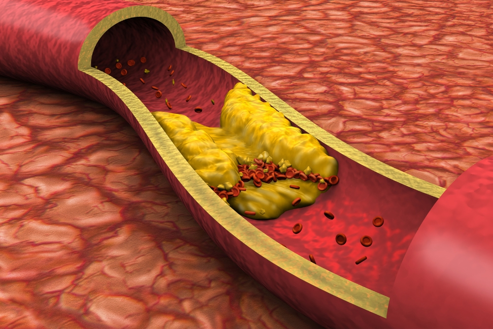 Symptoms and Risk Factors for Carotid Artery Disease